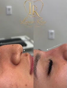 Antes e depois de tratamento no nariz, de perfil