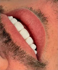 Sorriso após tratamento, visto de lado
