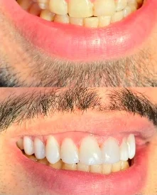Antes e depois de tratamento no sorriso
