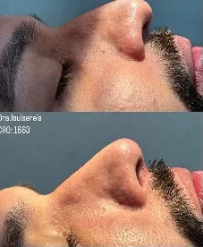 Antes e depois de tratamento no nariz, de perfil